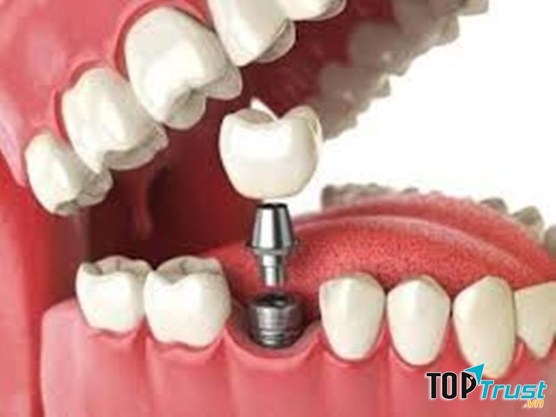 địa chỉ trồng răng implant tốt nhất tại Đà Nẵng