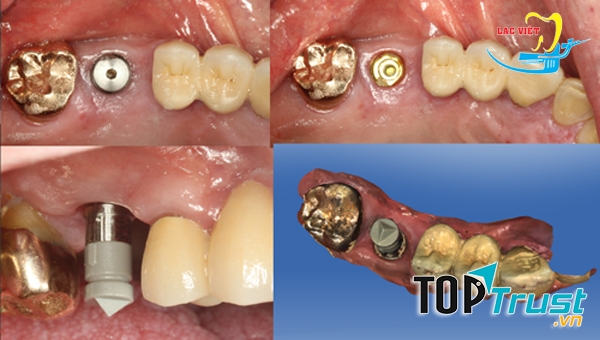 địa chỉ trồng răng implant uy tín nhất quận Cầu Giấy, Hà Nội