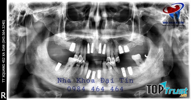 địa chỉ trồng  răng implant uy tín nhất quận Hai Bà Trưng, Hà Nội