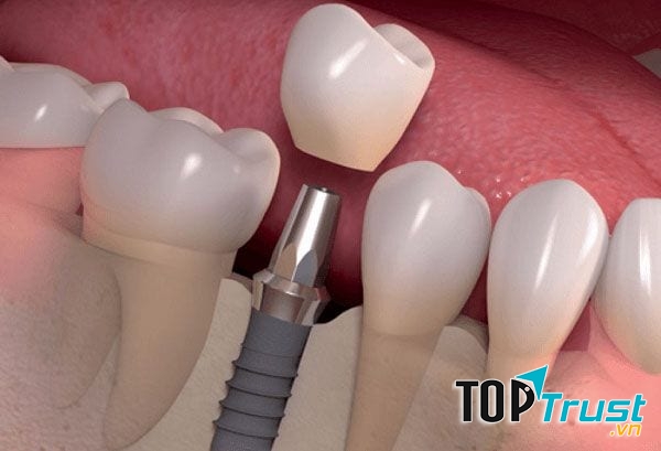 địa chỉ trồng  răng implant uy tín nhất quận Long Biên, Hà Nội