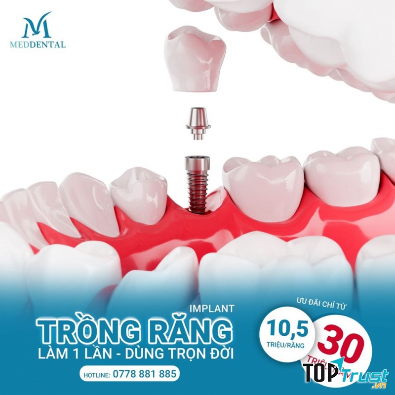 địa chỉ trồng  răng implant uy tín nhất quận Thanh Xuân, Hà Nội