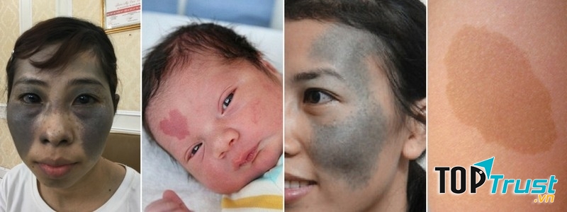 địa chỉ xóa chàm bớt bẩm sinh hiệu quả nhất Hà Nội