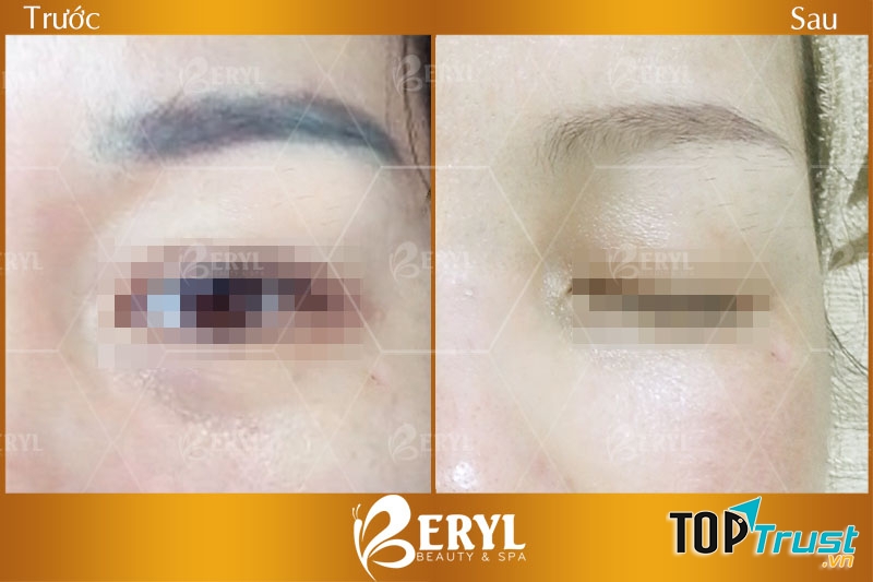 Địa chỉ xóa xăm chân mày uy tín và hiệu quả nhất TP. HCM