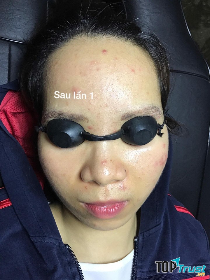 Địa chỉ xoá xăm mí, mày uy tín nhất Hà Nội