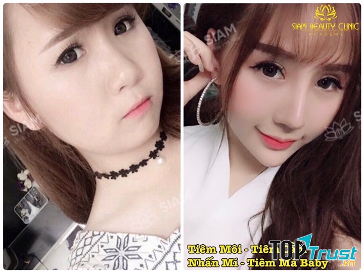 Địa điểm tiêm filler- botox uy tín tại Hà Nội