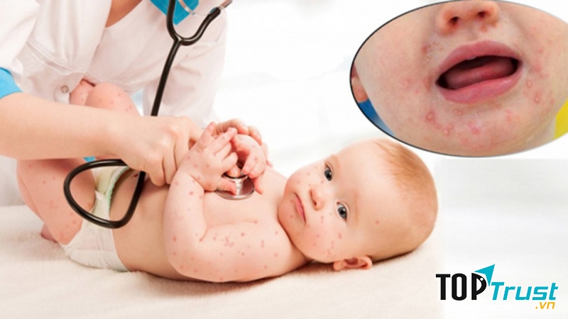 điều bố mẹ nên biết về bệnh tay chân miệng ở trẻ nhỏ