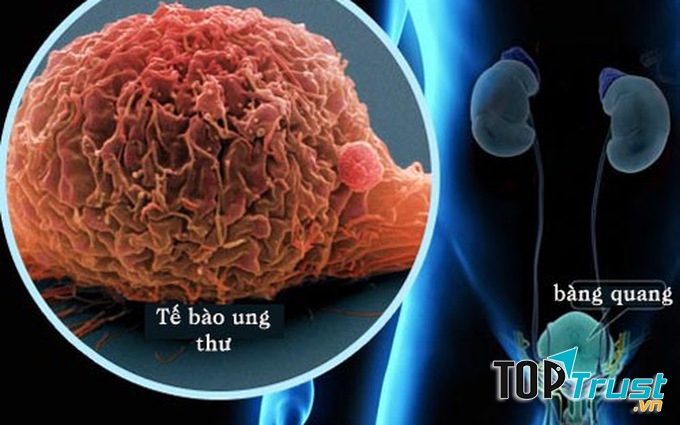 điều cần biết nhất về căn bệnh ung thư bàng quang