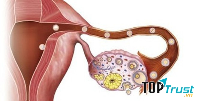 điều cần biết nhất về căn bệnh ung thư buồng trứng