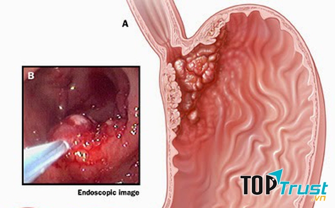 điều cần biết nhất về căn bệnh ung thư dạ dày