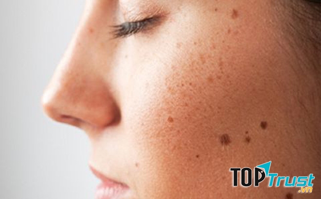 điều cần biết nhất về căn bệnh ung thư da