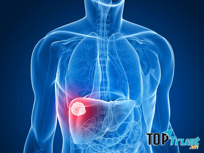 điều cần biết nhất về căn bệnh ung thư gan