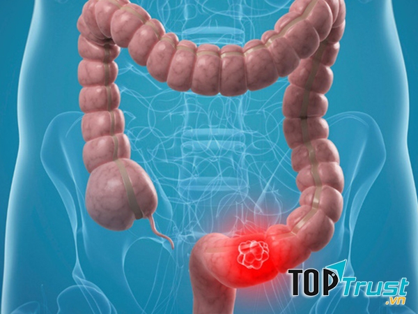 điều cần biết nhất về căn bệnh ung thư ruột non