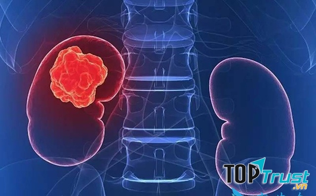 điều cần biết nhất về căn bệnh ung thư thận