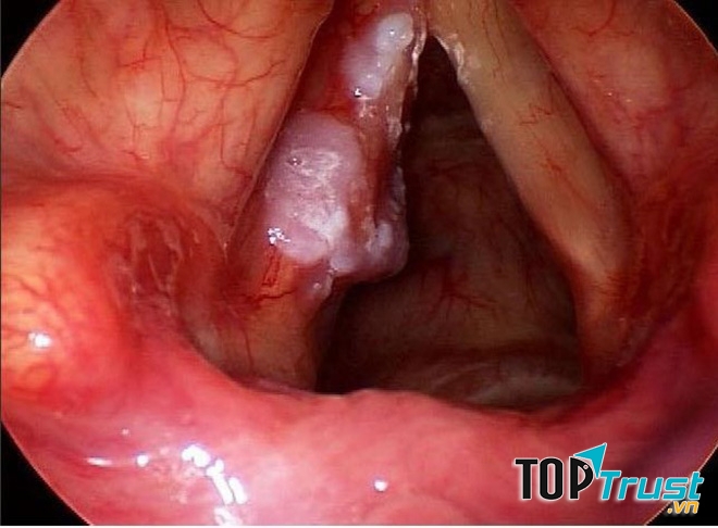 điều cần biết nhất về căn bệnh ung thư thanh quản