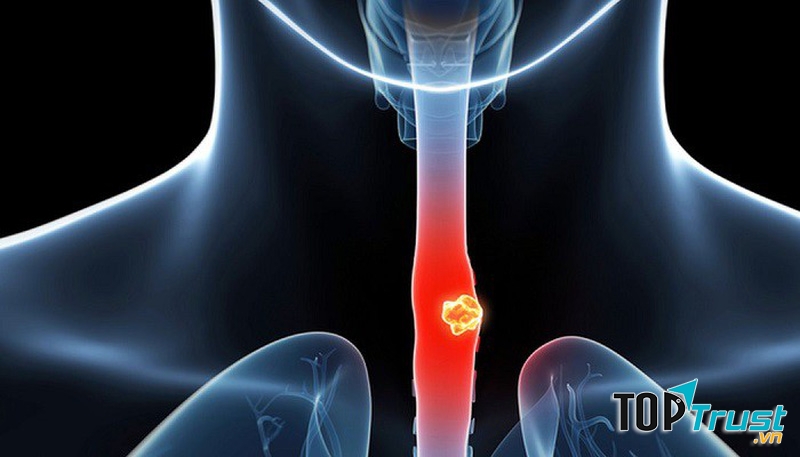 điều cần biết nhất về căn bệnh ung thư thực quản