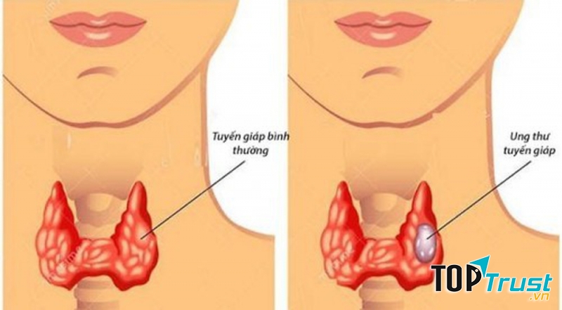 điều cần biết nhất về căn bệnh ung thư tuyến giáp