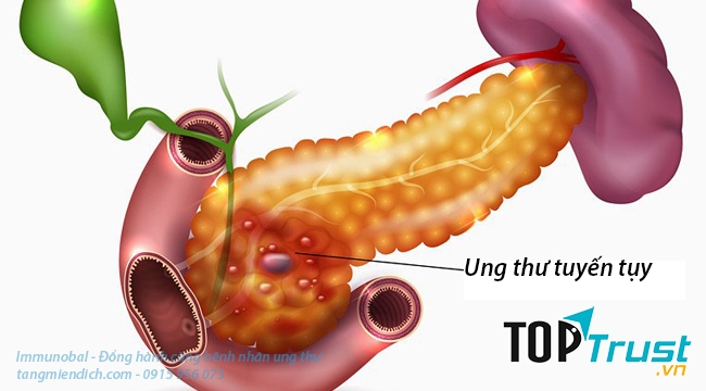 điều cần biết nhất về căn bệnh ung thư tuyến tụy