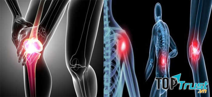 điều cần biết nhất về căn bệnh ung thư xương