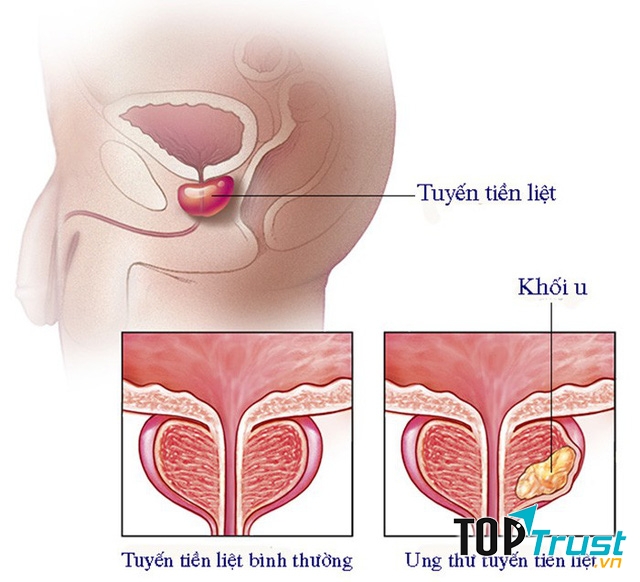 điều cần biết nhất về ung thư tuyến tiền liệt