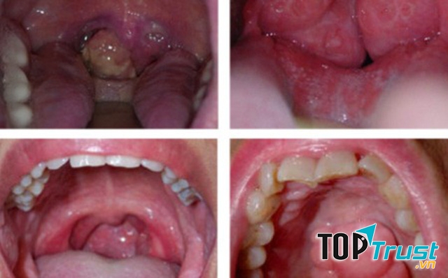 điều cần biết nhất về ung thư vòm họng