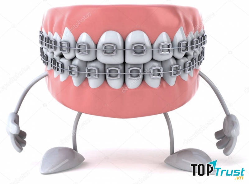 Điều cần biết trước khi niềng răng