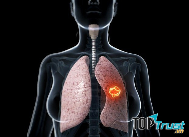 điều cần biết về căn bệnh ung thư phổi