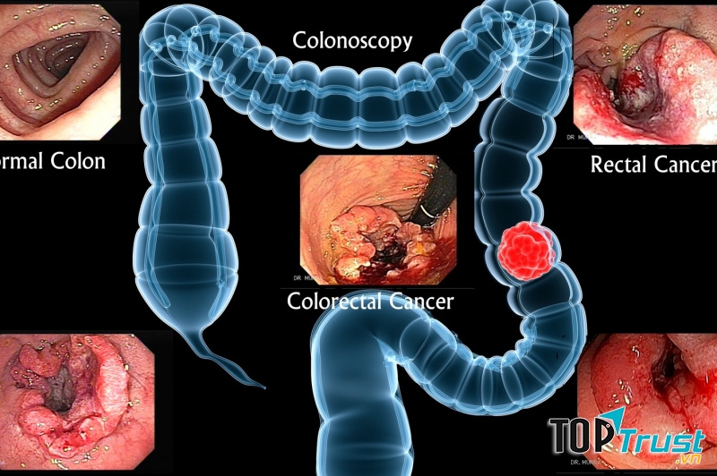 điều cần biết về Ung thư đại tràng