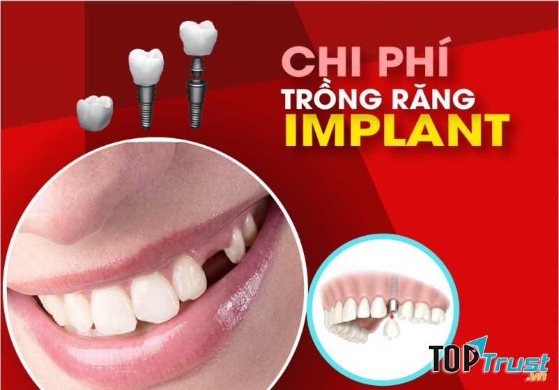 Giới thiệu về dịch vụ trồng răng Implant của Nha Khoa Đông Nam