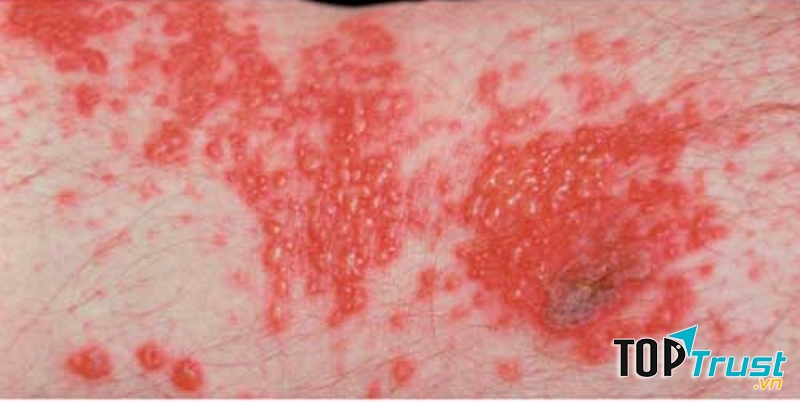 Hiểu biết cơ bản nhất về bệnh chàm bạn cần biết