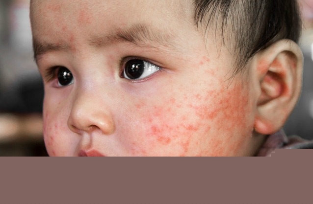 Kem bôi đặc trị chàm cho bé hiệu quả nhất hiện nay