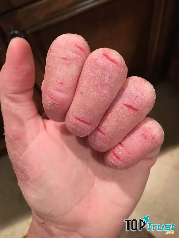 Kem bôi trị á sừng hiệu quả nhất hiện nay