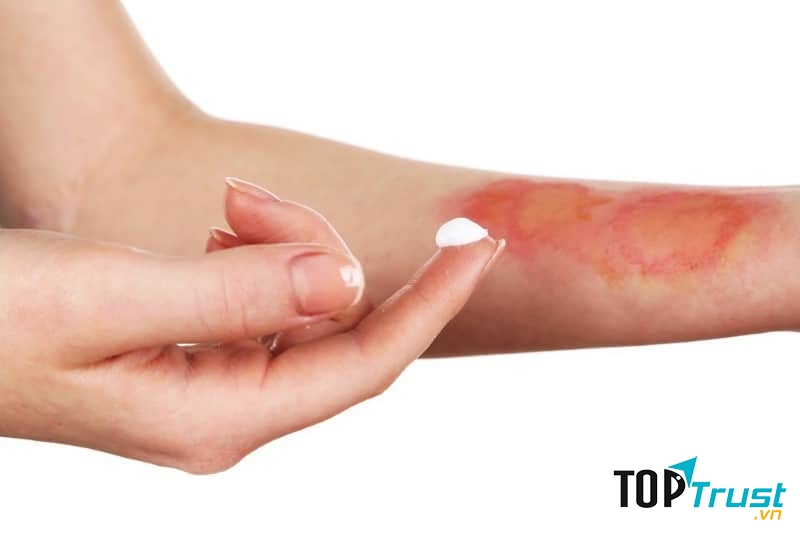 Kem trị bỏng hiệu quả nhất hiện nay