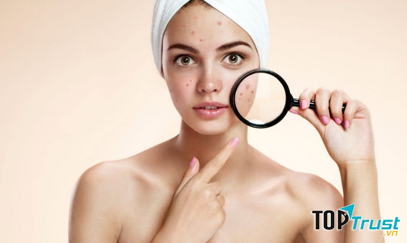 Kem trị mụn cho da khô tốt nhất hiện nay.