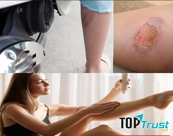 Kem trị sẹo bỏng bô tốt nhất trên thị trường hiện nay