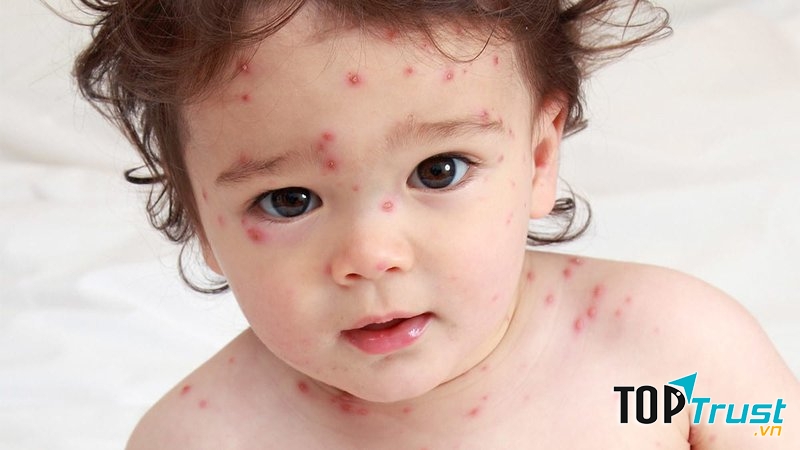 Lá thuốc tắm chữa bệnh thủy đậu hiệu quả mẹ nên biết