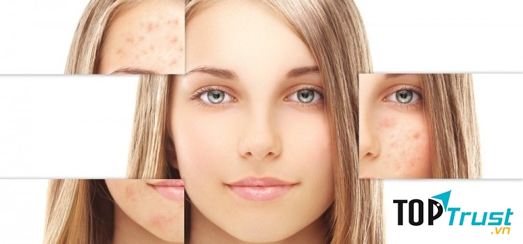 Loại kem trị nám da tốt nhất