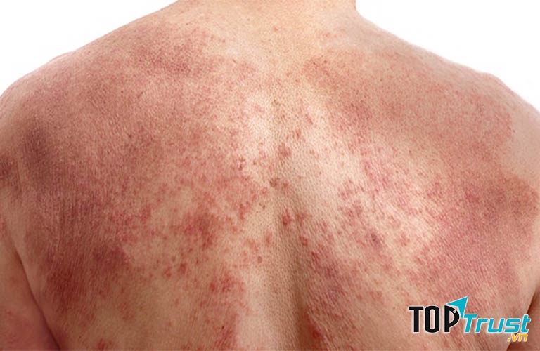 Loại lá trị viêm da cơ địa hiệu quả nhất