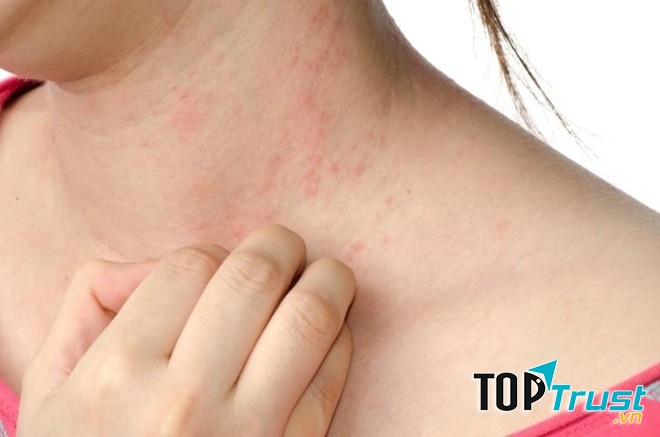 Loại thực phẩm dễ gây dị ứng nhất