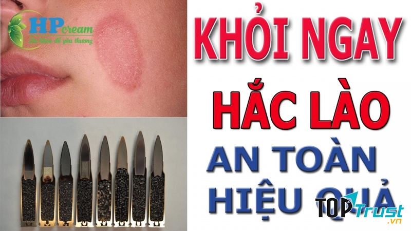 Loại thuốc trị hắc lào tốt và hiệu quả nhất