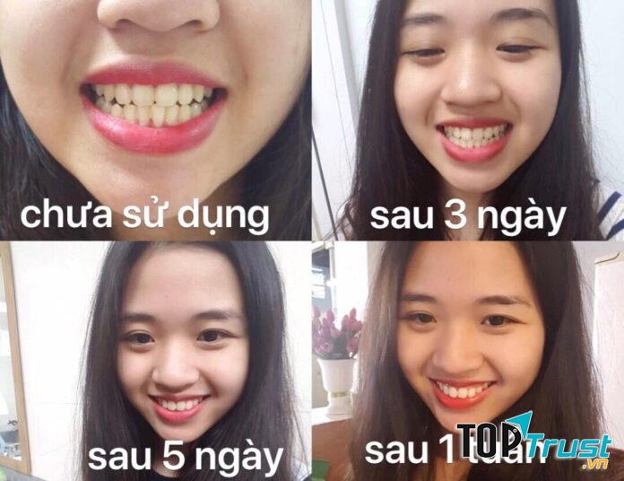 Máy làm trắng răng tại nhà hiệu quả nhất