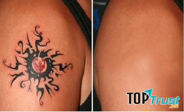 Máy xóa xăm tốt nhất dành cho spa