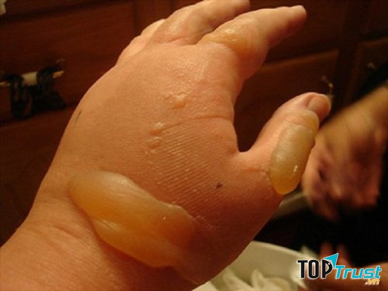 Mẹo chữa bỏng bằng kinh nghiệm dân gian đơn giản nhất