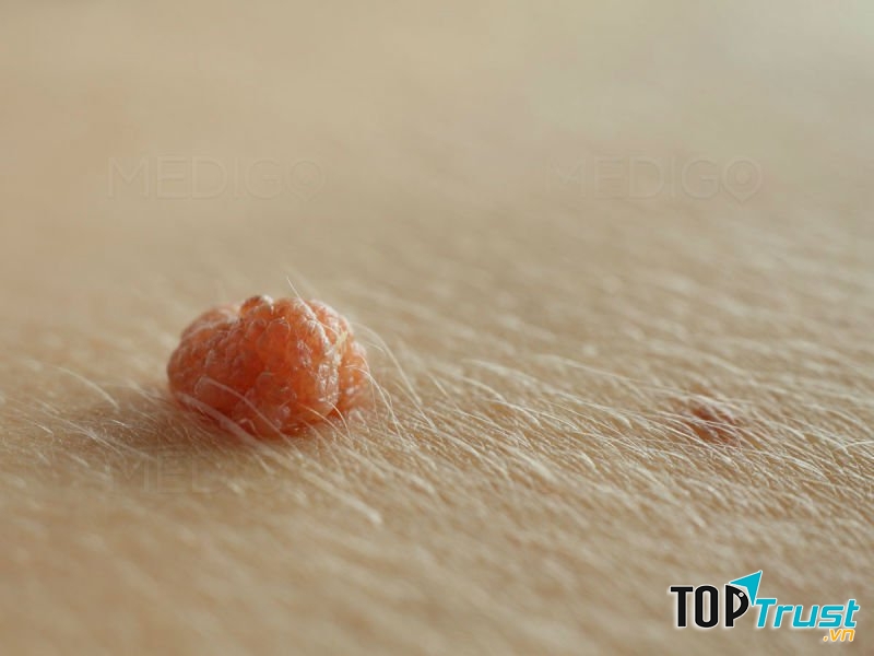 Miếng dán trị mụn cóc hiệu quả nhất