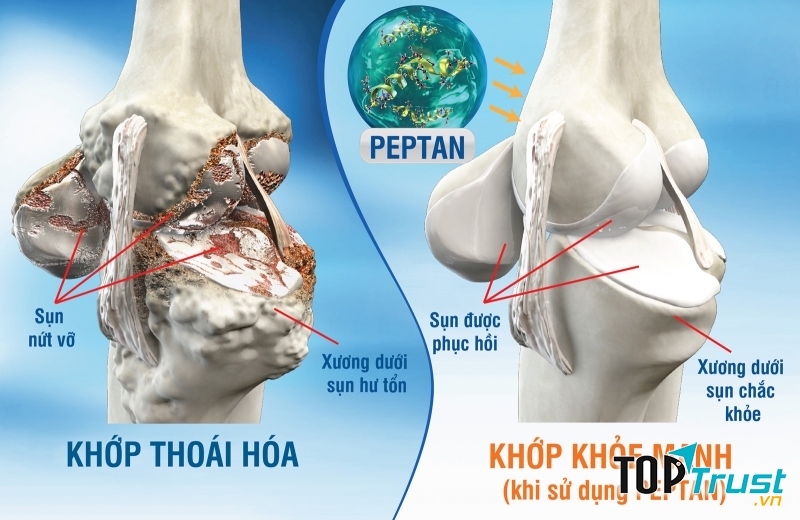 Nguyên nhân dẫn đến bệnh về khớp bạn nên chú ý