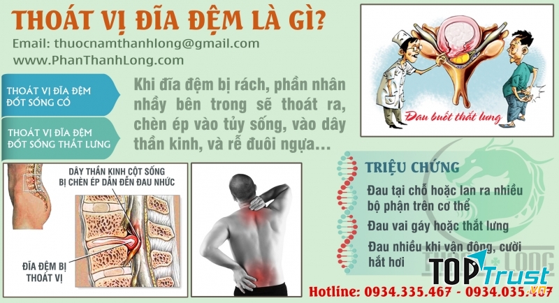 Nguyên nhân dẫn đến thoát vị đĩa đệm bạn cần biết