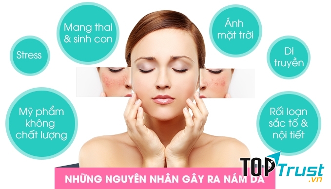 Nguyên nhân gây ra nám da khiến bạn mất tự tin