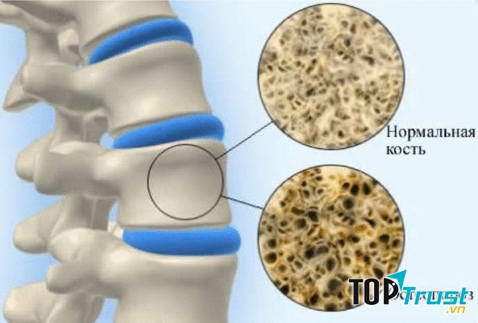 Nhóm thực phẩm giúp ngăn ngừa loãng xương hiệu quả