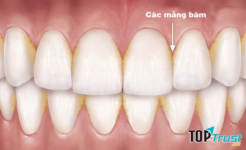 Nước súc miệng ngăn ngừa mảng bám răng hiệu quả nhất