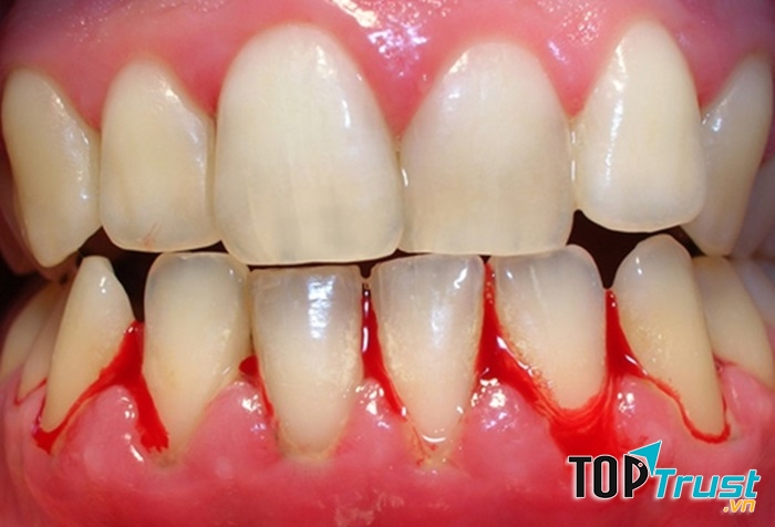 Nước súc miệng ngừa viêm nướu hiệu quả nhất cho cả nhà