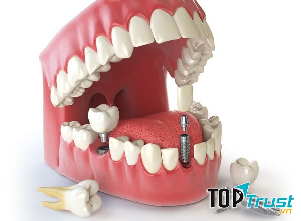 Phương pháp trồng răng an toàn và hiệu quả nhất hiện nay